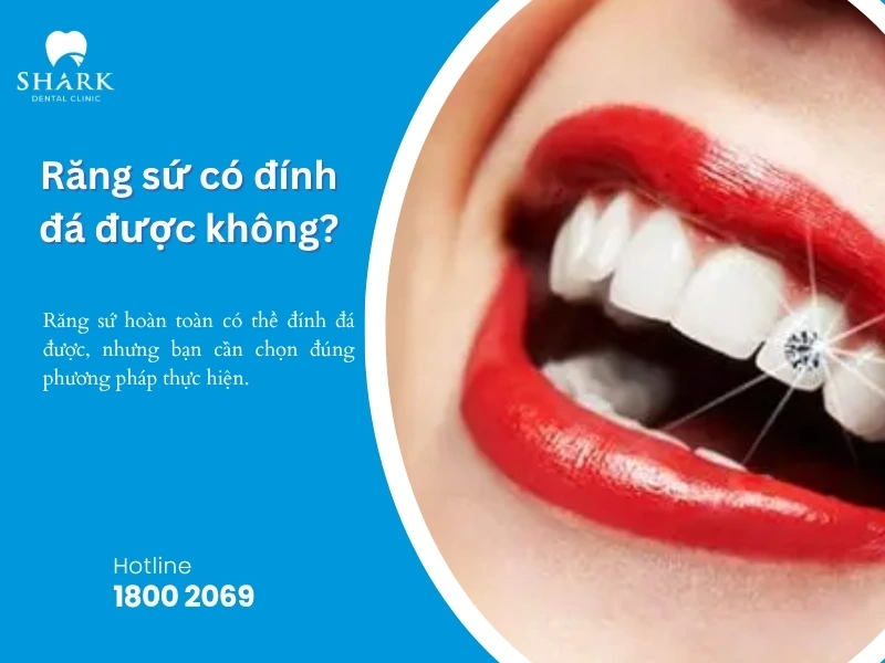 Răng sứ có thể đính đá bằng keo dán