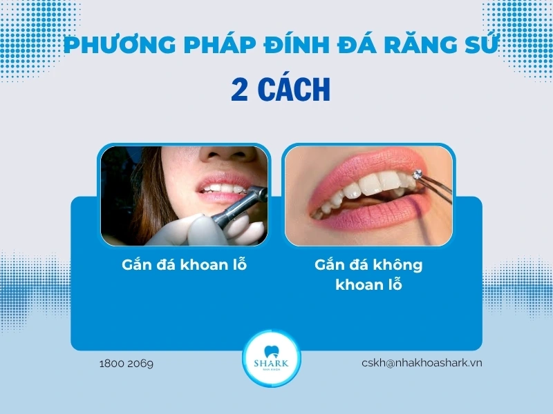 2 phương pháp đính đá lên răng phổ biến nhất hiện nay