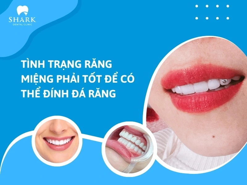 Chỉ nên đính đá lên răng sứ khi tình trạng răng tốt và không gặp bệnh lý nha khoa