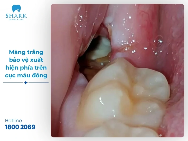 Một số hình ảnh sau khi nhổ răng khôn bạn nên tham khảo 23 Hình ảnh 4: Màng trắng bảo vệ xuất hiện phía trên cục máu đông, đây là biểu hiện của quá trình biểu mô hóa bình thường, không phải mủ