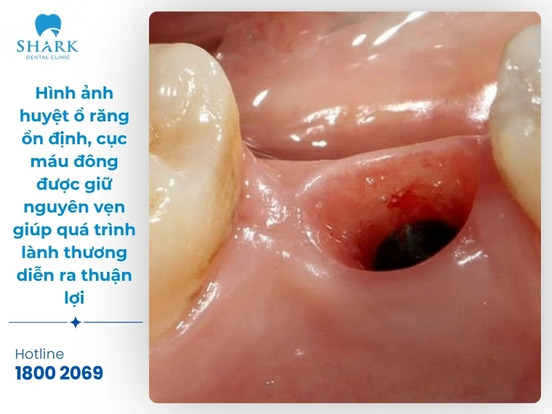 Một số hình ảnh sau khi nhổ răng khôn bạn nên tham khảo 24 Hình ảnh 5: Hình ảnh huyệt ổ răng ổn định, cục máu đông được giữ nguyên vẹn giúp quá trình lành thương diễn ra thuận lợi