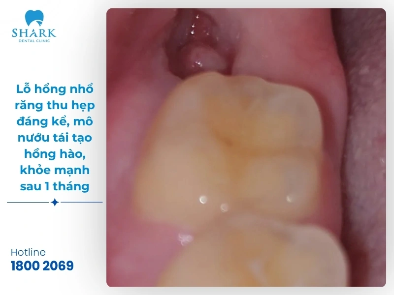 Một số hình ảnh sau khi nhổ răng khôn bạn nên tham khảo 26 Hình ảnh 2: Lỗ hổng nhổ răng thu hẹp đáng kể, mô nướu tái tạo hồng hào, khỏe mạnh sau 1 tháng