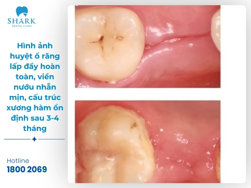 Một số hình ảnh sau khi nhổ răng khôn bạn nên tham khảo 27 Hình ảnh 3: Hình ảnh huyệt ổ răng lấp đầy hoàn toàn, viền nướu nhẵn mịn, cấu trúc xương hàm ổn định sau 3-4 tháng
