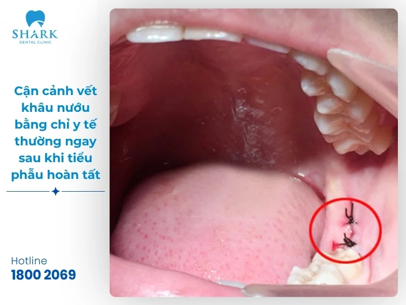 Một số hình ảnh sau khi nhổ răng khôn bạn nên tham khảo 15 Hình ảnh 1: Cận cảnh vết khâu nướu bằng chỉ y tế thường ngay sau khi tiểu phẫu hoàn tất