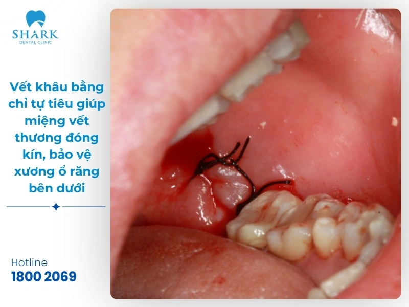 Một số hình ảnh sau khi nhổ răng khôn bạn nên tham khảo 16 Hình ảnh 2: Vết khâu bằng chỉ tự tiêu giúp miệng vết thương đóng kín, bảo vệ xương ổ răng bên dưới