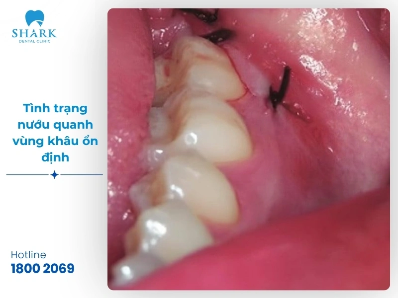 Một số hình ảnh sau khi nhổ răng khôn bạn nên tham khảo 17 Hình ảnh 3: Tình trạng nướu quanh vùng khâu ổn định, không tấy đỏ bất thường sau 3 ngày nhổ răng