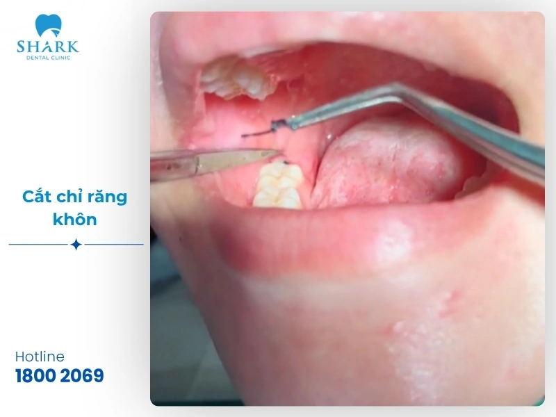Một số hình ảnh sau khi nhổ răng khôn bạn nên tham khảo 19 Hình ảnh 5: Bác sĩ tiến hành thao tác cắt chỉ nhẹ nhàng, dứt khoát cho khách hàng tại nha khoa sau 7 ngày