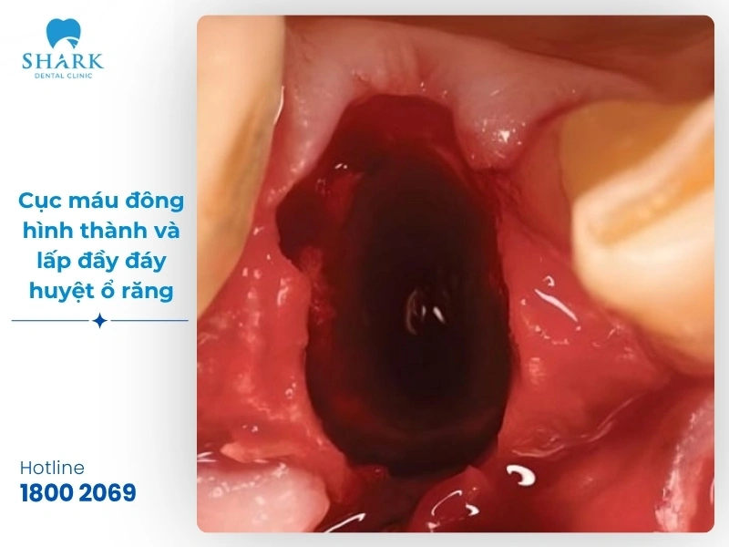 Một số hình ảnh sau khi nhổ răng khôn bạn nên tham khảo 20 Hình ảnh 1: Cục máu đông hình thành và lấp đầy đáy huyệt ổ răng vững chắc sau 24 giờ đầu tiên