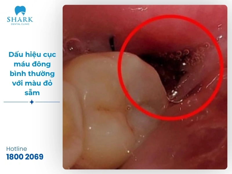Một số hình ảnh sau khi nhổ răng khôn bạn nên tham khảo 21 Hình ảnh 2: Dấu hiệu cục máu đông bình thường với màu đỏ sẫm, máu đã ngừng chảy hoàn toàn