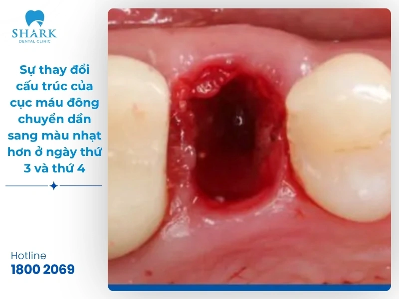 Một số hình ảnh sau khi nhổ răng khôn bạn nên tham khảo 22 Hình ảnh 3: Sự thay đổi cấu trúc của cục máu đông chuyển dần sang màu nhạt hơn ở ngày thứ 3 và thứ 4