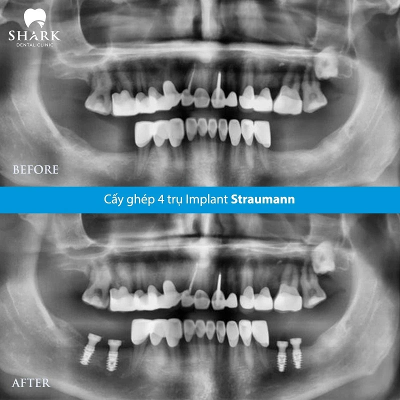 Cấy trụ Implant đơn lẻ ở cho răng hàm để đảm bảo ăn nhai tốt