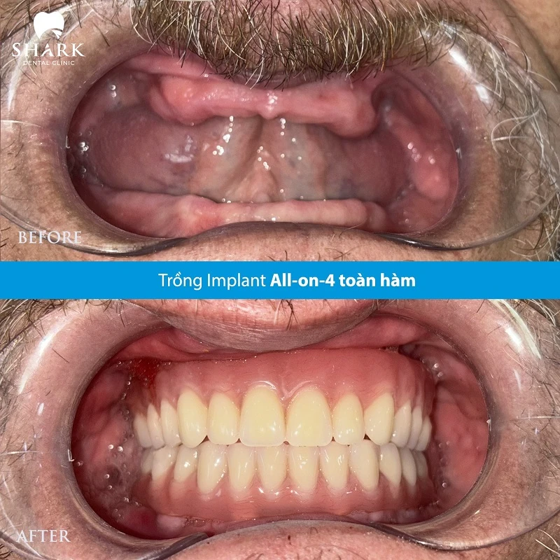 Hình ảnh trước và sau khi cấy toàn hàm bằng trụ Implant Straumann