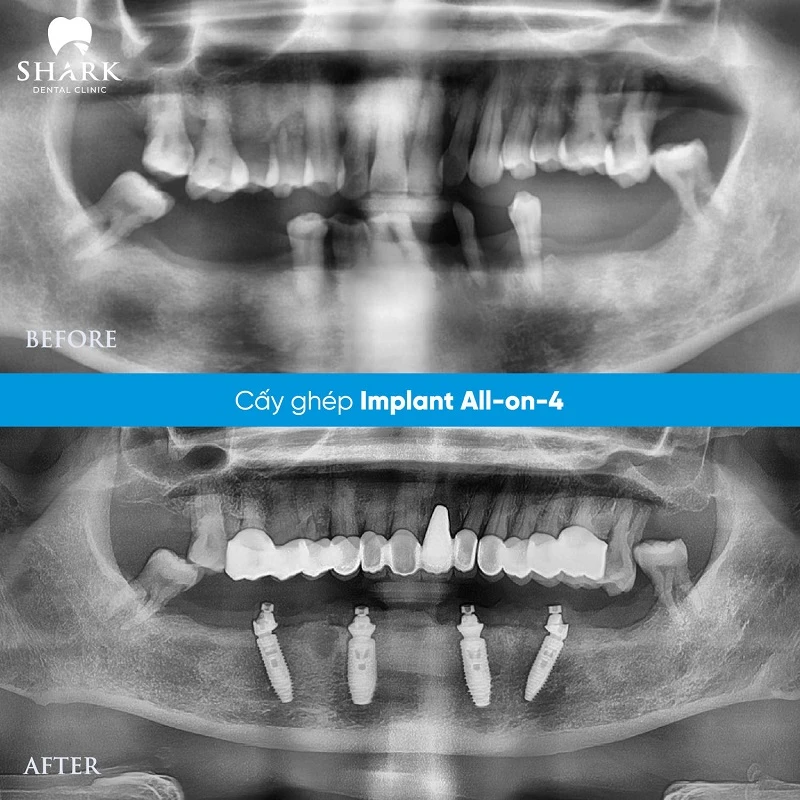 X-quang chú Hùng cấy ghép trụ Straumann tại Nha khoa Shark