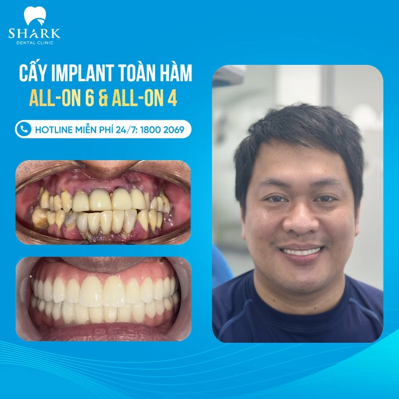 Trồng răng Implant mất bao lâu? Tổng thời gian cấy cho 1 người 12 Anh Hoàng Nam khôi phục nụ cười và sức khỏe răng miệng sau khi cấy ghép răng