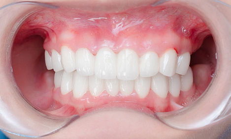 Kết quả điều trị Võ Thị Bảo Ngân