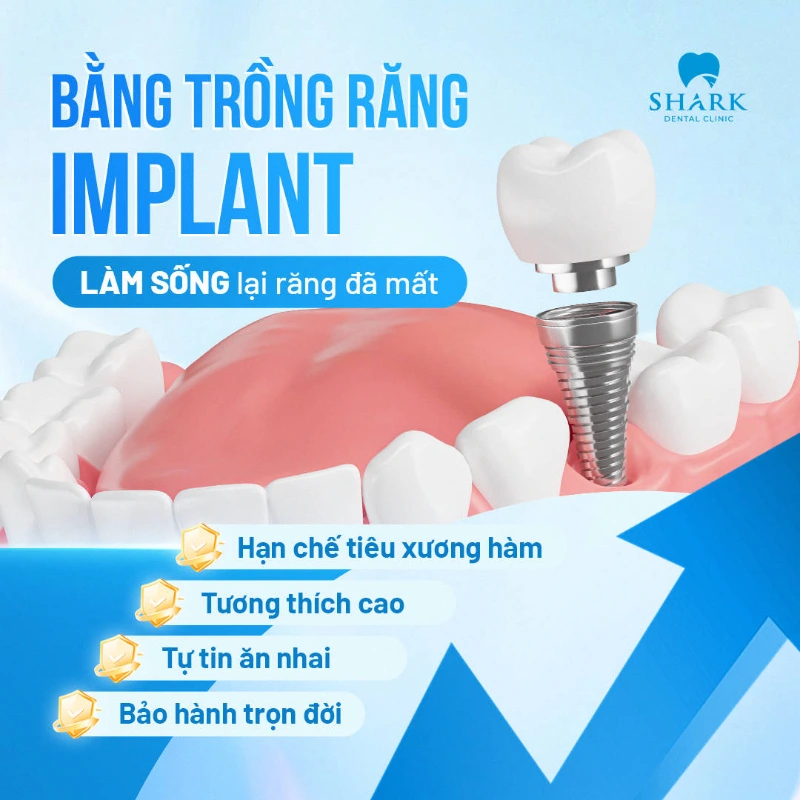 Trồng răng sứ không có chân răng bằng phương pháp nào tốt nhất? 8 Cấy ghép Implant là phương pháp phục hình răng bị mất chân răng tốt nhất