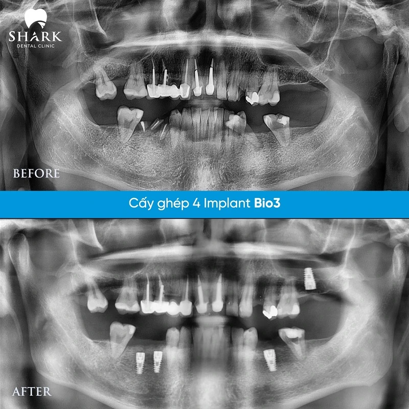 X-quang răng của chị Hoa sau khi cấy Implant cho hàm dưới