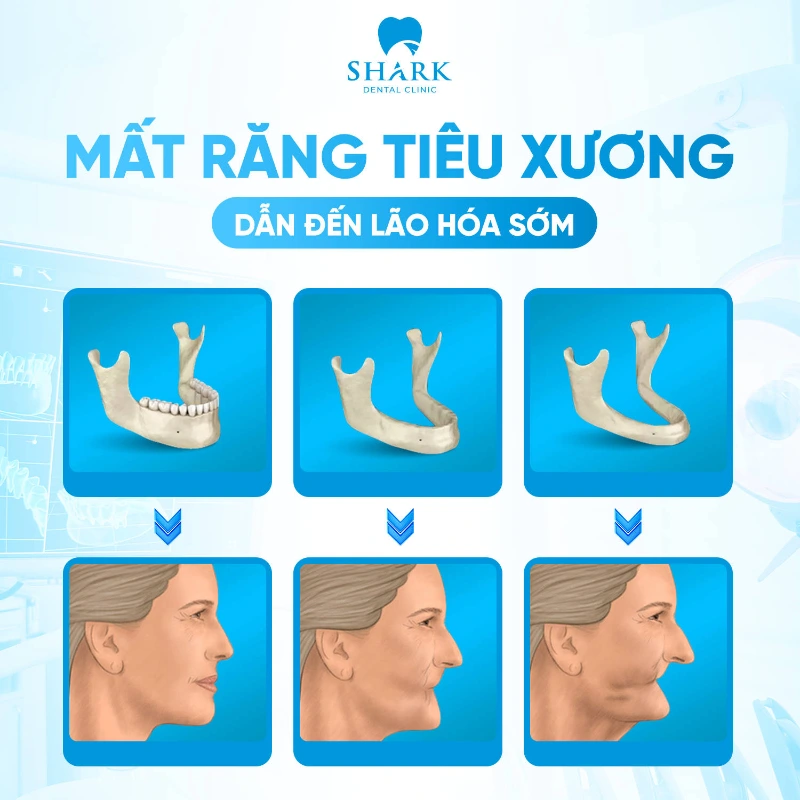 Mất răng bao lâu thì bị tiêu xương hàm? Giải pháp khắc phục 13 Mất răng bị tiêu xương hàm dẫn đến gương mặt bị lão hóa sớm