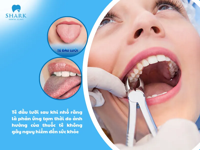 Tê đầu lưỡi sau khi nhổ răng là phản ứng tạm thời do ảnh hưởng của thuốc tê không gây nguy hiểm đến sức khỏe