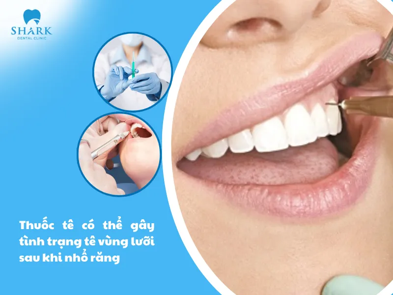 Thuốc tê có thể gây tình trạng tê vùng lưỡi sau khi nhổ răng