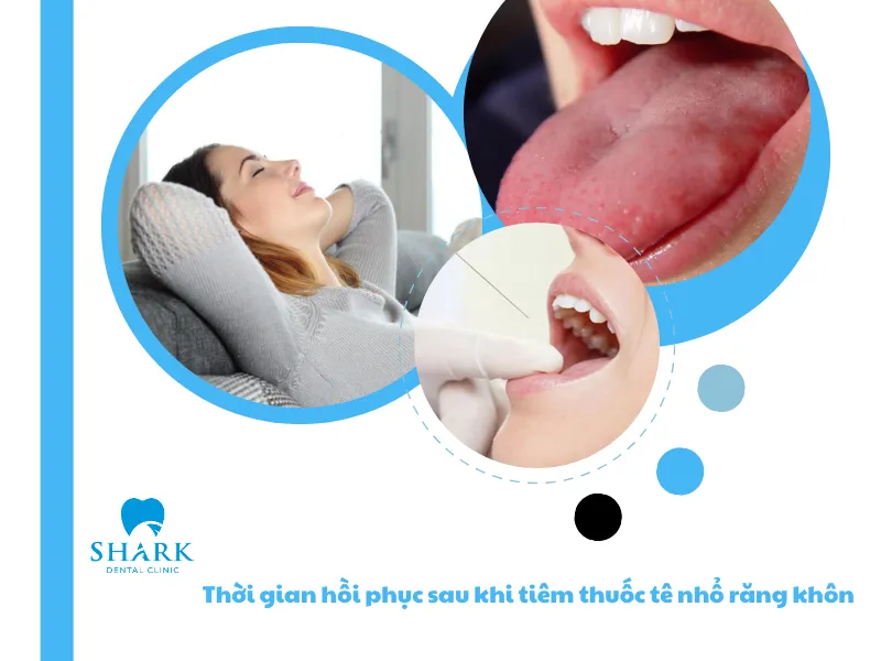 Thời gian hồi phục sau khi tiêm thuốc tê nhổ răng khôn