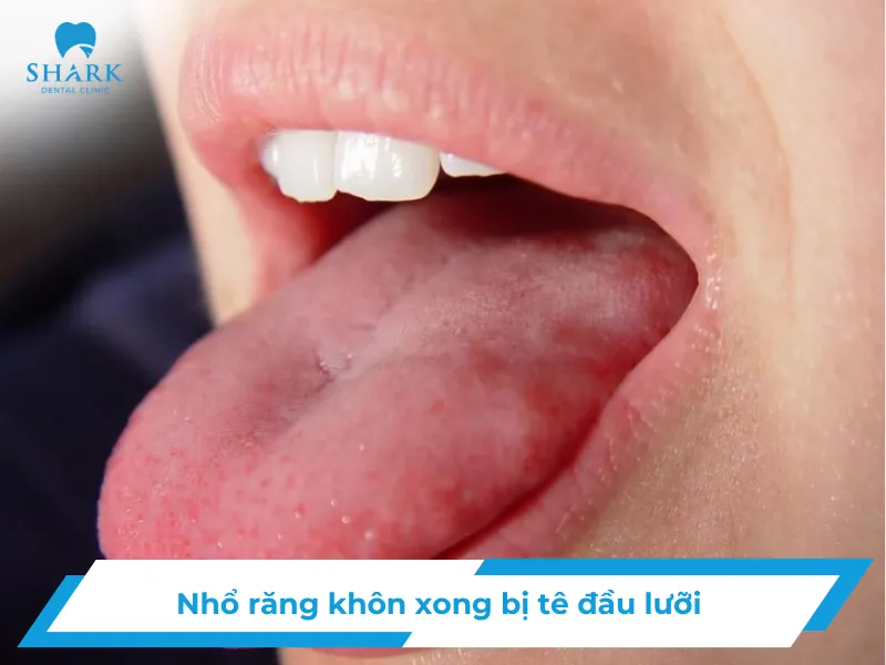 Nhổ răng khôn xong bị tê đầu lưỡi - Nguyên nhân và cách xử lý