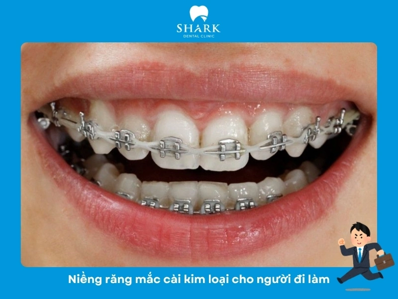 Niềng răng mắc cài kim loại cho người đi làm