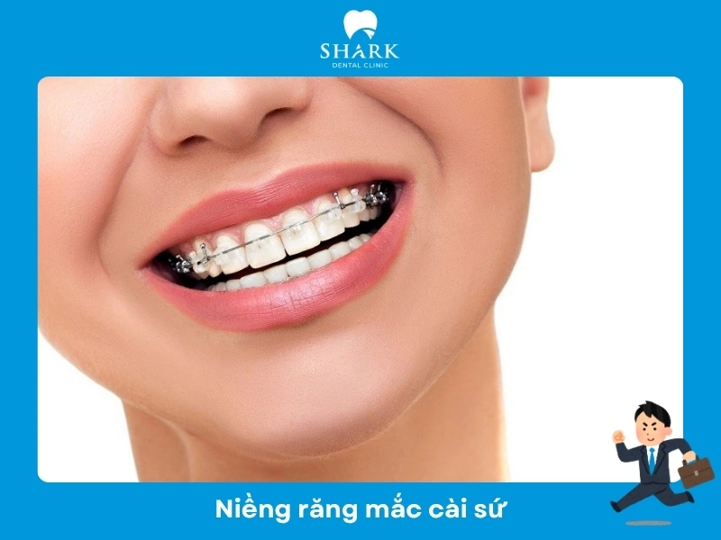 Mắc cài sứ cho người đang đi làm