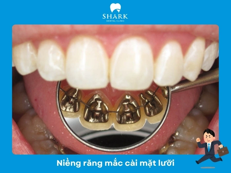 Niềng mắc cài mặt trong phù hợp với người đi làm cần giao tiếp nhiều