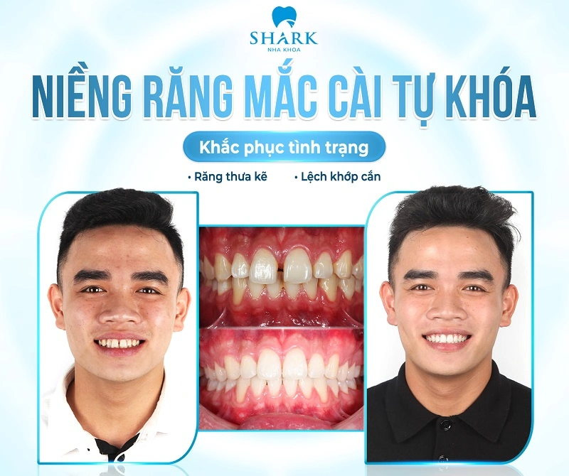 Anh Tuấn niềng răng thành công tại Nha khoa Shark