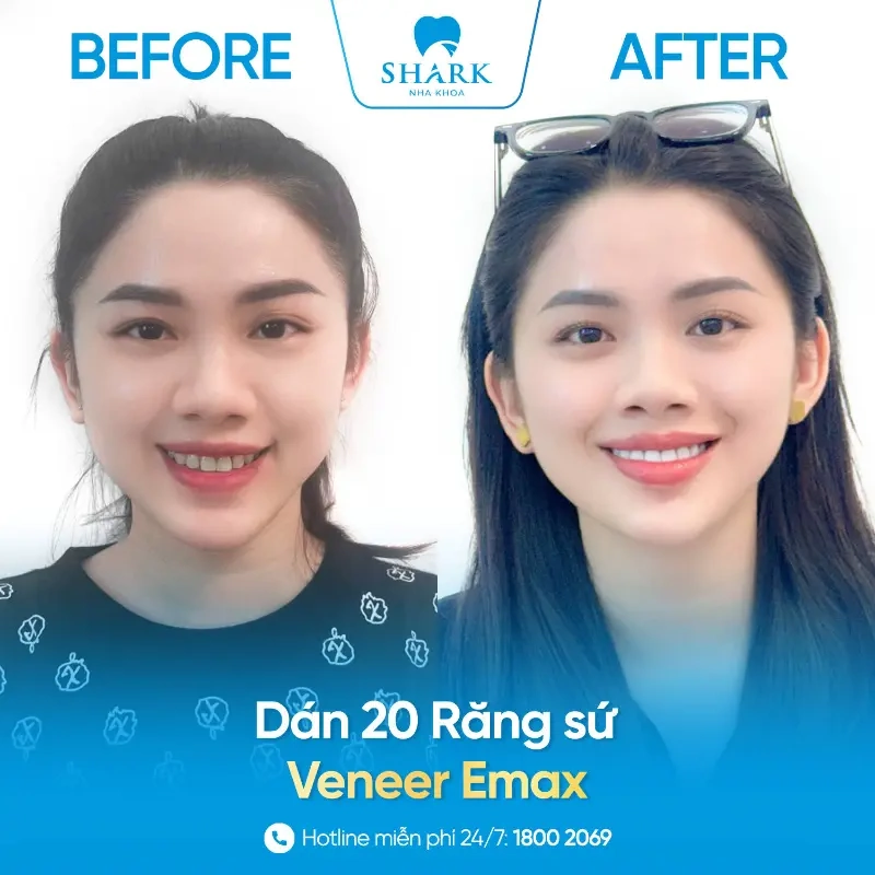 Phủ sứ Nano là gì? Giá bao nhiêu và có tác hại gì không? 10 Dán sứ Veneer tại nha khoa Shark