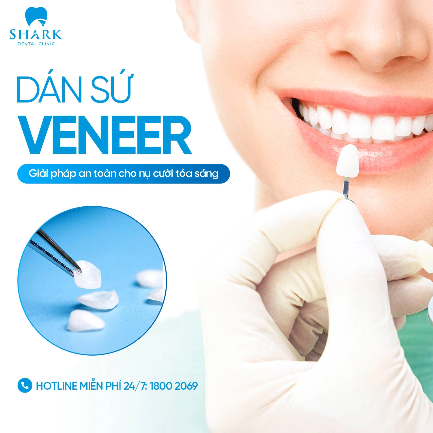 Phủ sứ Nano là gì? Giá bao nhiêu và có tác hại gì không? 9 Dán răng sứ Veneer là trải nghiệm tốt hơn phủ sứ