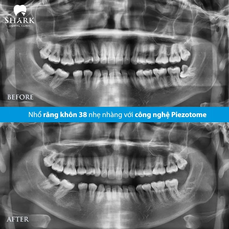 Thuốc tê nhổ răng khôn có ảnh hưởng đến thai nhi không? 9 Chị Nhung đã thực hiện nhổ 1 răng khôn 38 khi đang mang thai tháng thứ 5.