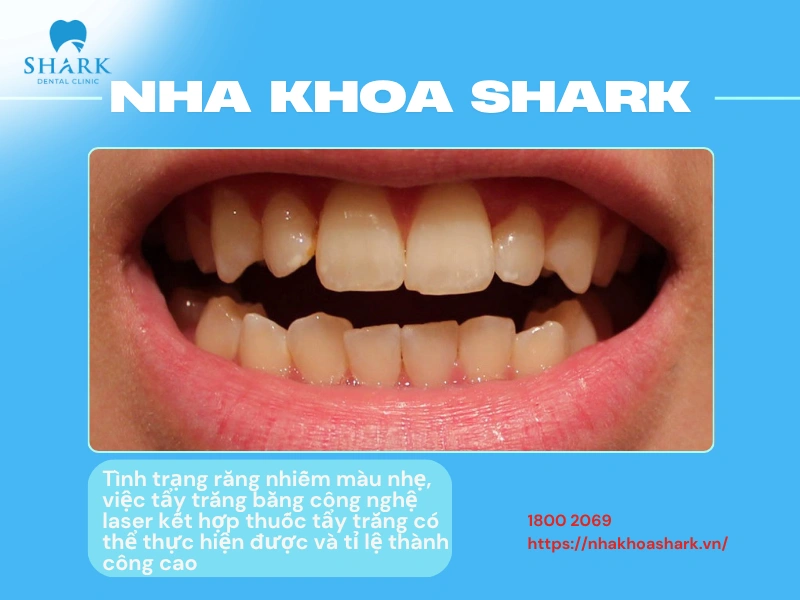 Với tình trạng răng nhiễm màu nhẹ, việc tẩy trắng là hoàn toàn có thể thực hiện được