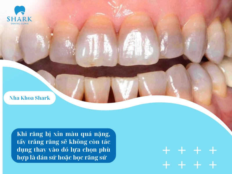 Việc răng đã bị xỉn màu quá nặng, tẩy trắng răng sẽ không còn là lựa chọn mang lại hiệu quả tối ưu