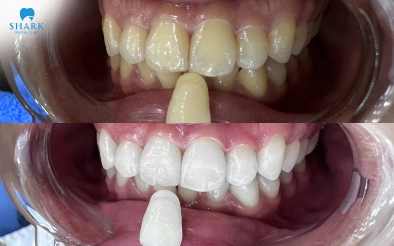 Hình ảnh trước và sau của khách hàng sử dụng dịch vụ tẩy trắng răng tại Nha khoa Shark