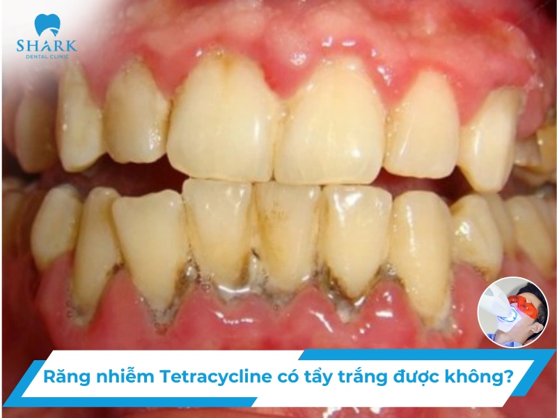 Răng nhiễm Tetracycline có tẩy trắng được không?