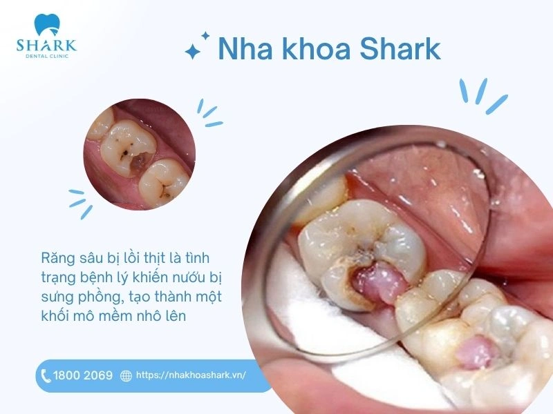 Răng sâu lồi thịt là một tình trạng bệnh lý răng miệng nghiêm trọng khiến vùng nướu bị sưng phồng, tạo thành một khối mô mềm nhô lên 