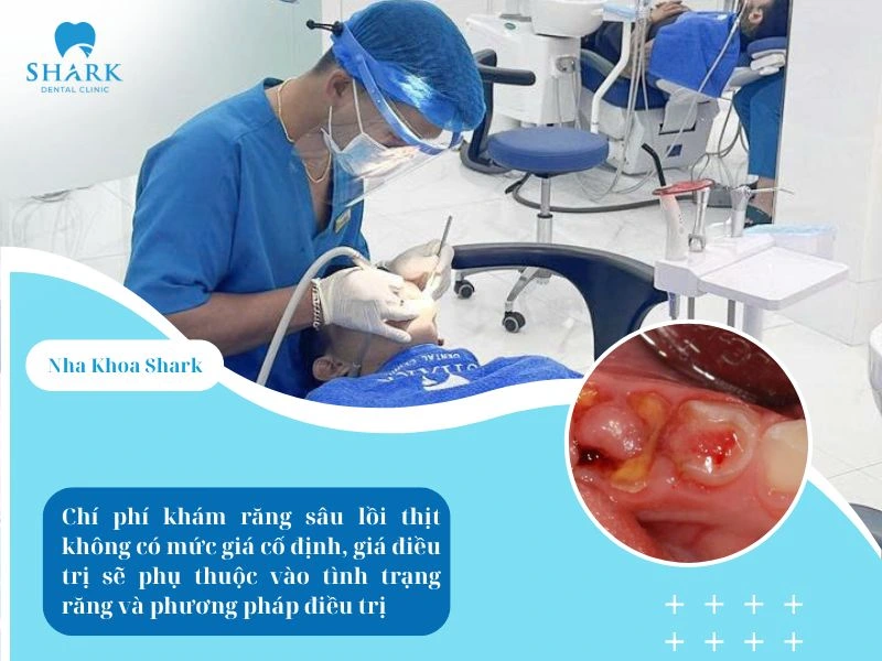 Chi phí điều trị răng sâu lồi thịt không có mức giá cố định, vì còn phụ thuộc vào tình trạng răng và phương pháp điều trị
