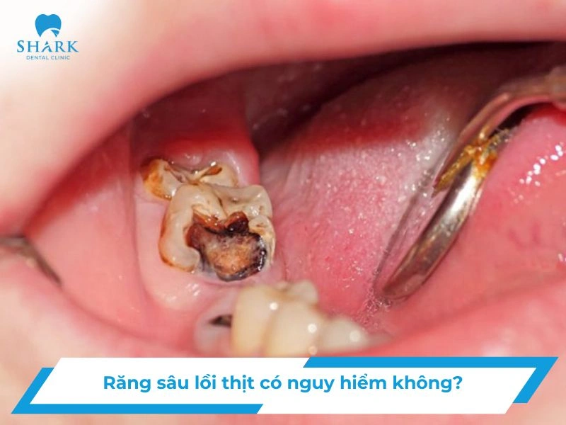 Răng sâu lồi thịt có nguy hiểm không?