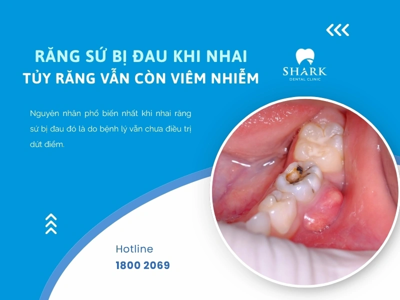 Răng sứ đau khi nhai có thể là do viêm tủy răng