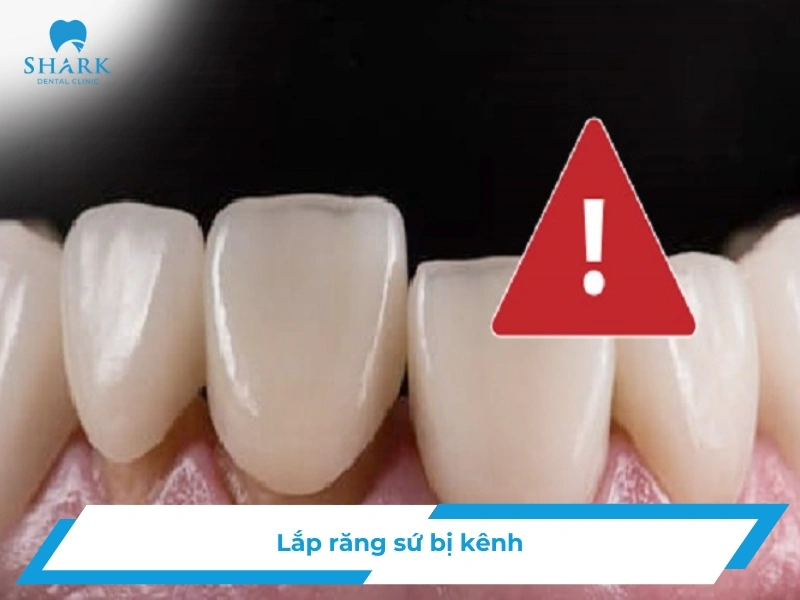 Lắp răng sứ bị kênh: Nguyên nhân, dấu hiệu và cách khắc phục 12 Làm răng sứ bị kênh