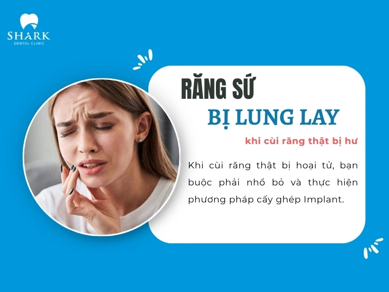 Răng sứ lung lay khi cùi răng thật bị hư hoàn toàn thì sẽ được chỉ định nhổ bỏ và cấy Implant