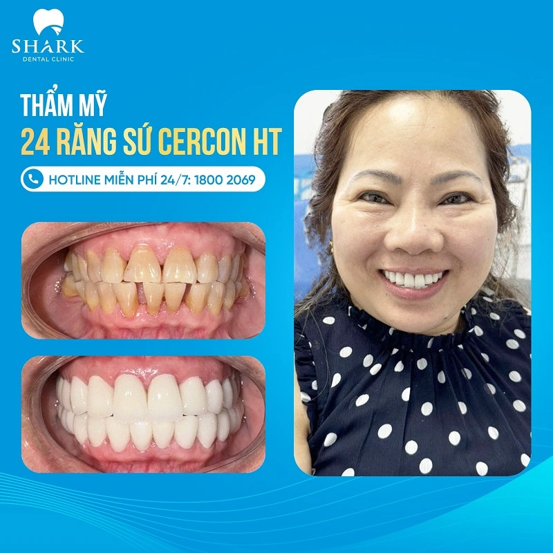 Thẩm mỹ răng sứ an toàn và không lung lay tại Nha khoa Shark