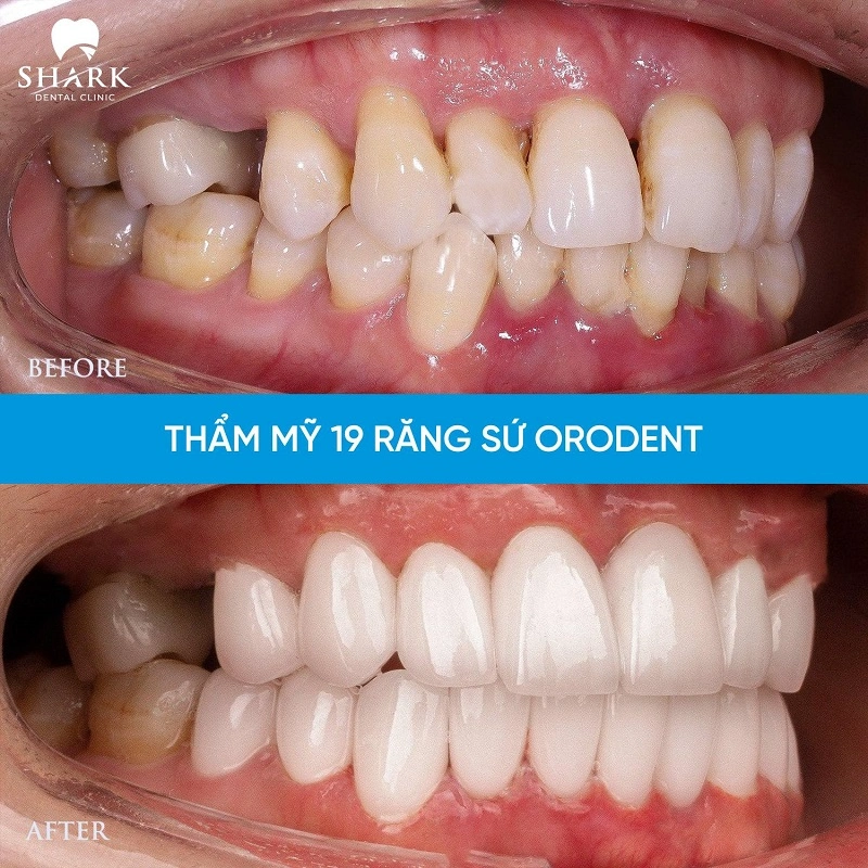 Hình ảnh khách hàng bọc sứ Orodent 19 răng tại Shark