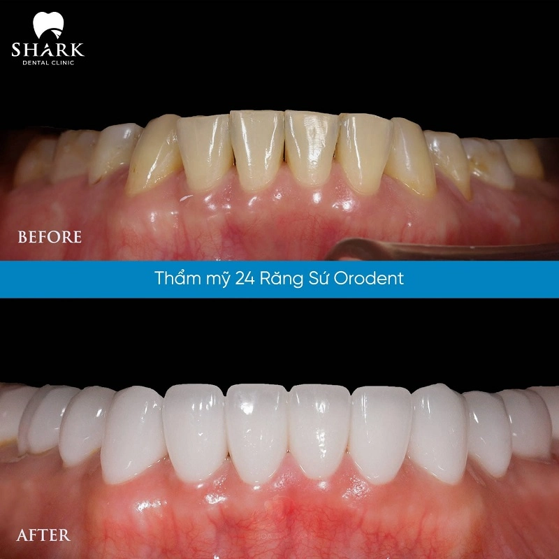 Hình ảnh khách hàng thẩm mỹ 24 răng sứ Orodent ở Nha khoa Shark