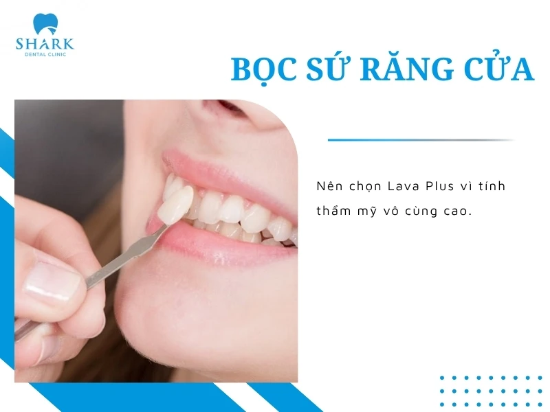 Bọc sứ răng cửa cần thẩm mỹ cao thì chọn Lava Plus