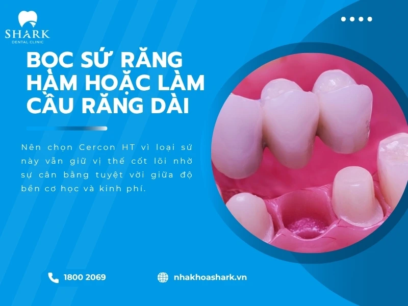 Bọc sứ răng hàm cần độ cứng thì chọn Cercon HT