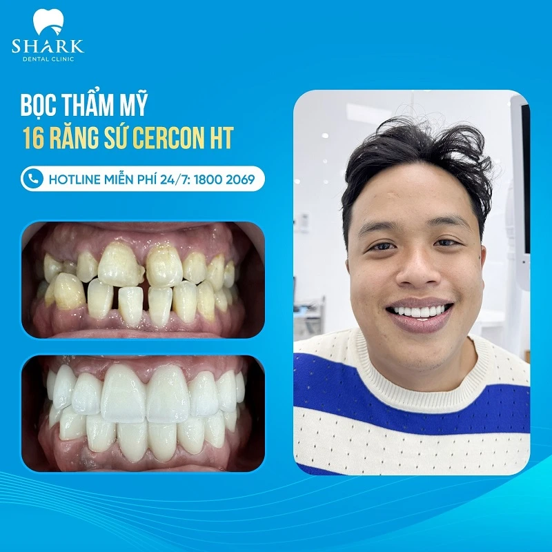 Anh Tuấn Tú bọc 16 răng sứ Cercon HT ở Nha khoa Shark