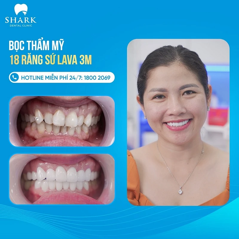 So sánh sứ kim loại và toàn sứ, nên chọn loại nào phù hợp? 9 Hình ảnh khách hàng bọc răng toàn sứ Lava tại Nha khoa Shark